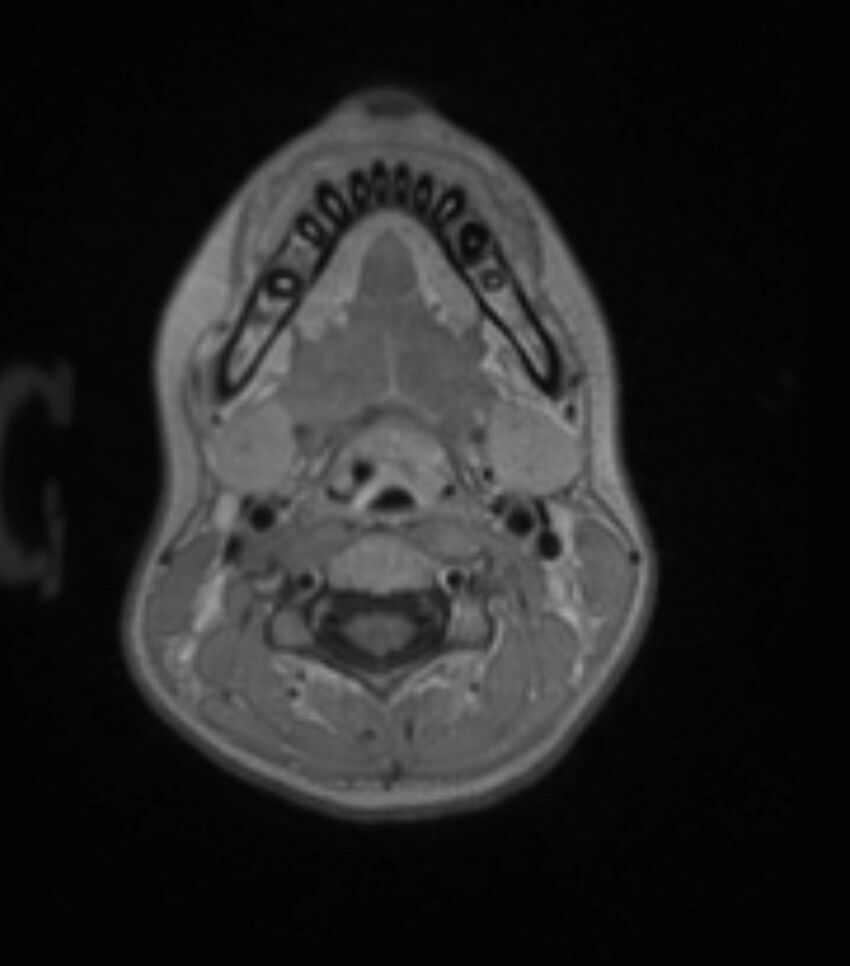 Choroid plexus carcinoma (Radiopaedia 91013-108553 Axial T1 C+ 26).jpg