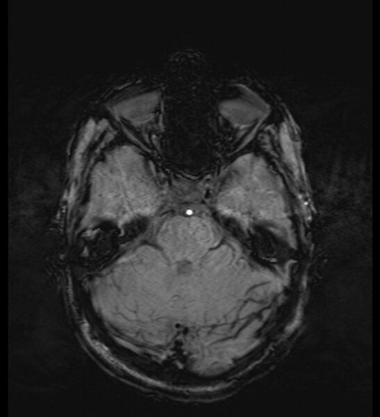File:Choroid plexus xanthogranuloma (Radiopaedia 91271-108875 Axial SWI 20).jpg