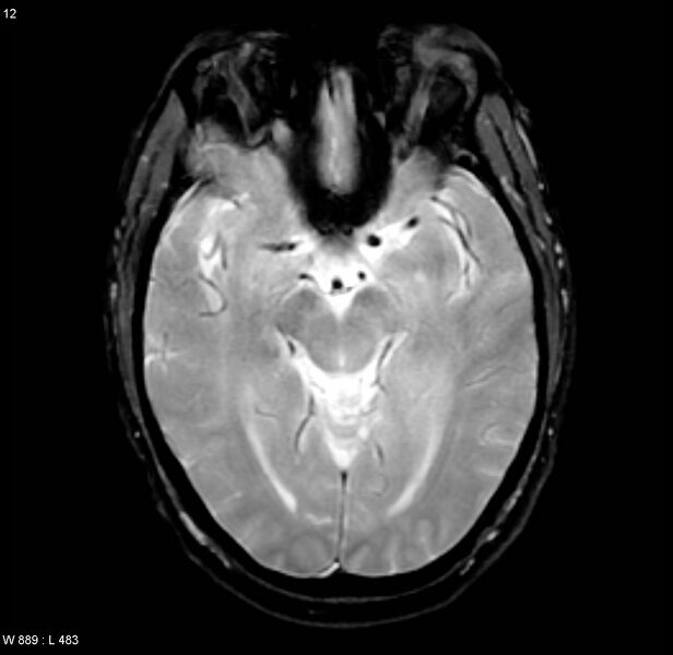 File:Chronic hypertensive encephalopathy (Radiopaedia 4564-6686 Axial Gradient Echo 7).jpg