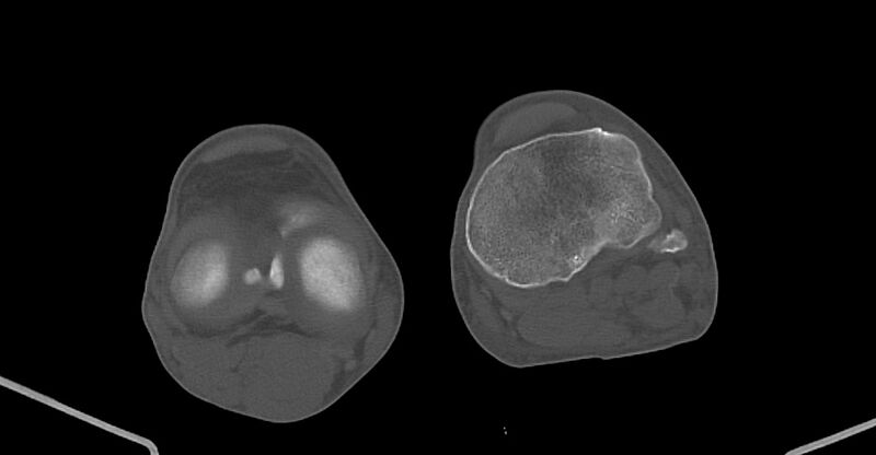 File:Chronic osteomyelitis (with sequestrum) (Radiopaedia 74813-85822 Axial non-contrast 195).jpg