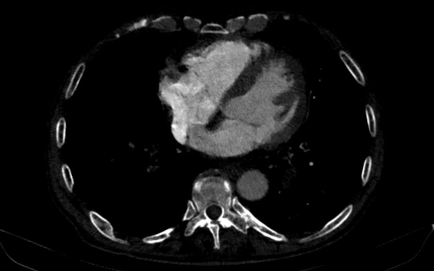Chronic pulmonary embolism (Radiopaedia 91241-108843 B 128).jpg