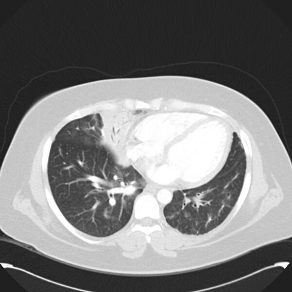 File:Chronic thromboembolic pulmonary hypertension (CTEPH) (Radiopaedia 74597-85531 Axial lung window 33).jpg