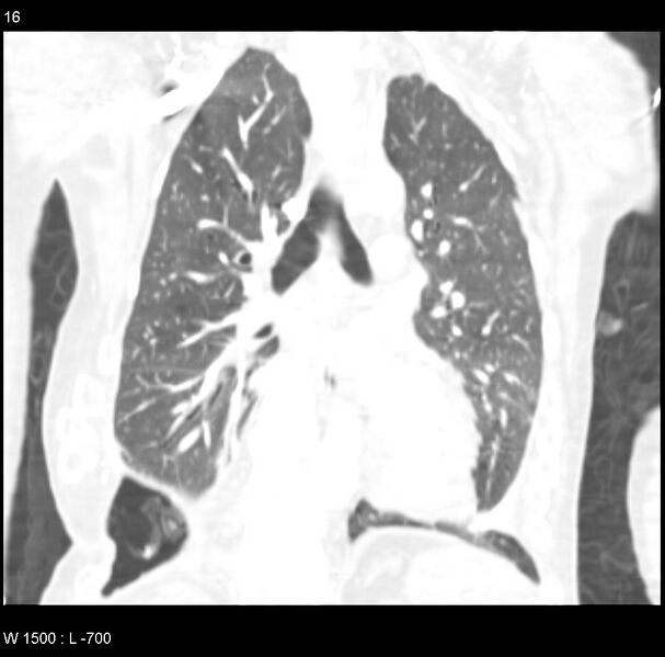 File:Clagett thoracotomy (Radiopaedia 8568-9403 Coronal lung window 16).jpg