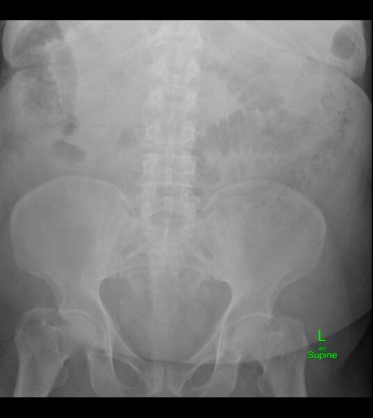 File:Closed-loop small bowel obstruction-internal hernia (Radiopaedia 78439-91095 B 1).jpg