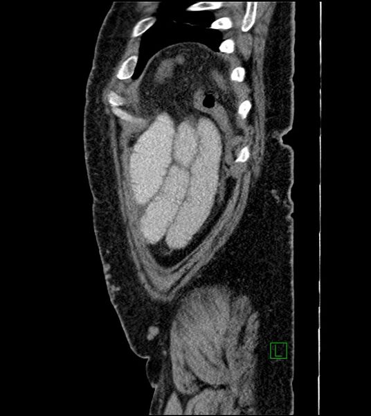 File:Closed-loop small bowel obstruction-internal hernia (Radiopaedia 78439-91096 C 25).jpg
