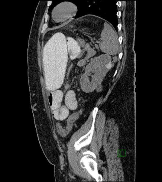 File:Closed-loop small bowel obstruction-internal hernia (Radiopaedia 78439-91096 C 43).jpg