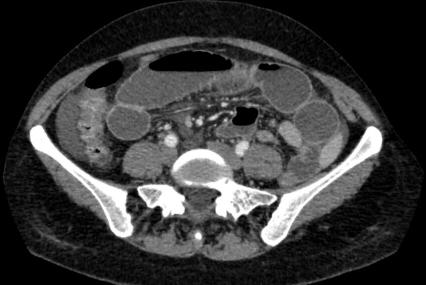 Closed loop small bowel obstruction (Radiopaedia 71211-81508 A 92).jpg