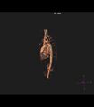 Coarctation of the aorta (Radiopaedia 43373-46729 3D reconstruction 14).jpg