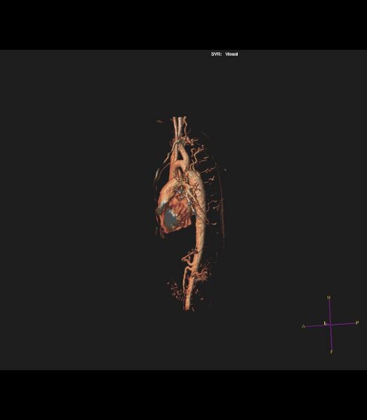 File:Coarctation of the aorta (Radiopaedia 43373-46729 3D reconstruction 14).jpg