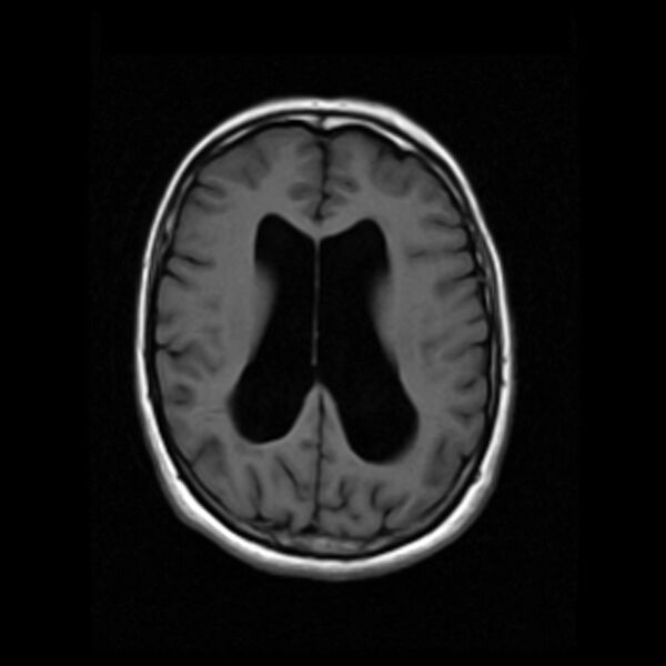 File:Colloid cyst with hydrocephalus (Radiopaedia 9373-10065 Axial T1 12).jpg