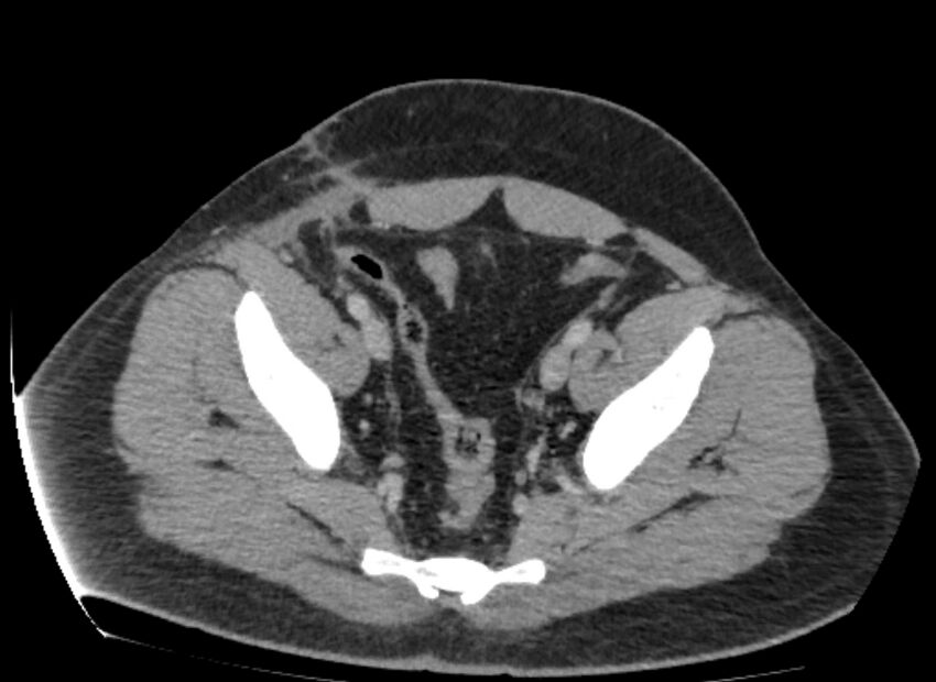 Colocutaneous fistula (Radiopaedia 56401-63062 A 81).jpg