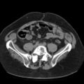 Colonic fistula (Radiopaedia 16047-15707 Axial non-contrast 39).jpg