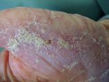 Crusted scabies