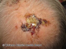 Erosive pustular dermatitis of the scalp