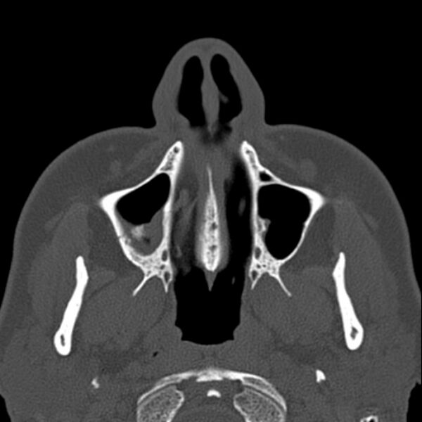 File:Nasal septal perforation (Radiopaedia 25030-25289 Axial bone window 6).jpg