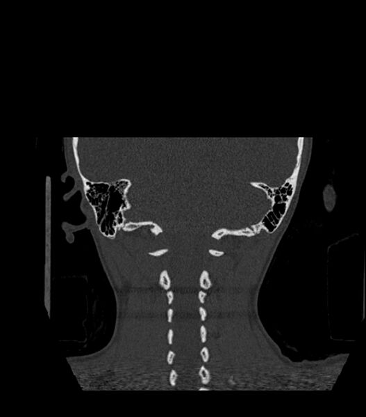 File:Nasoorbitoethmoid fracture (Radiopaedia 90044-107205 Coronal bone window 118).jpg