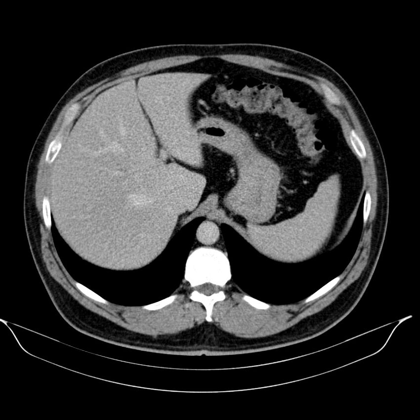 Neuroendocrine tumor of head of pancreas (Radiopaedia 57538-64502 D 19).jpg