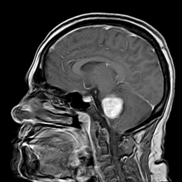 File:Neurofibromatosis type 2 (Radiopaedia 67470-76871 Sagittal T1 C+ 10).jpg