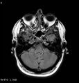 Neurosarcoidosis (Radiopaedia 10930-11351 Axial FLAIR 4).jpg