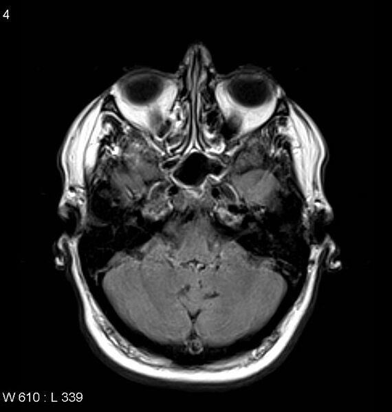 File:Neurosarcoidosis (Radiopaedia 10930-11351 Axial FLAIR 4).jpg