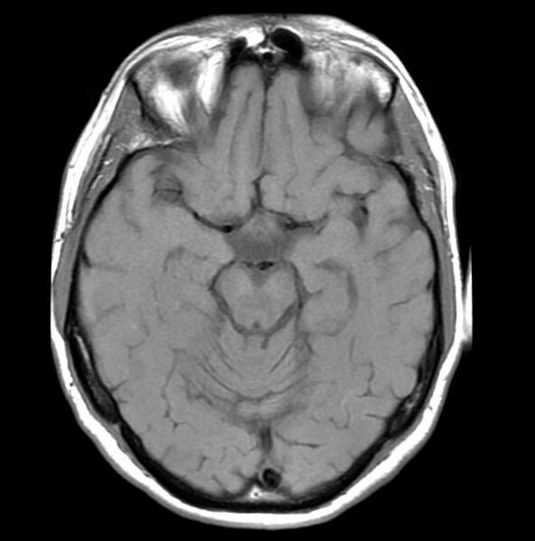 File:Neurosarcoidosis (Radiopaedia 11674-12037 Axial 3).jpg