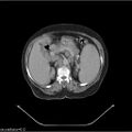 Non-Hodgkin lymphoma (Radiopaedia 27492-27690 B 18).jpg