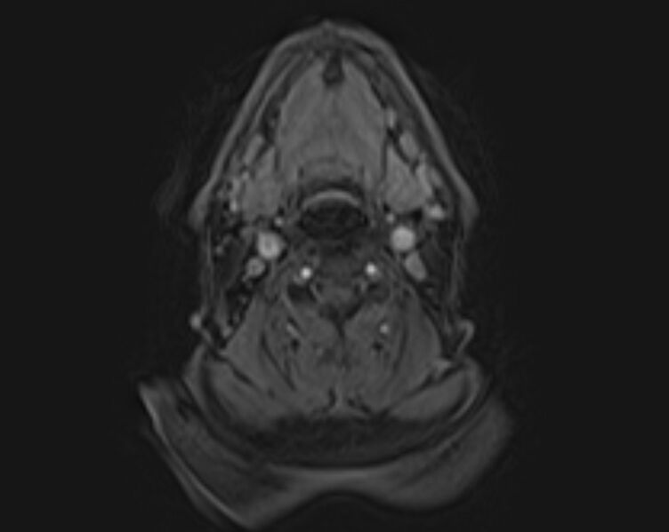 File:Non-Hodgkin lymphoma - parotid gland (Radiopaedia 71531-81890 E 28).jpg