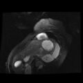 Non-compaction of the left ventricle (Radiopaedia 38868-41062 D 2).jpg