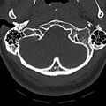 Normal CT of the cervical spine (Radiopaedia 53322-59305 Axial bone window 32).jpg