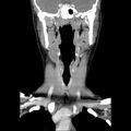 Normal CT of the neck (Radiopaedia 14575-14500 Coronal C+ 25).jpg