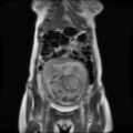 Normal MRI abdomen in pregnancy (Radiopaedia 88001-104541 Coronal T2 10).jpg