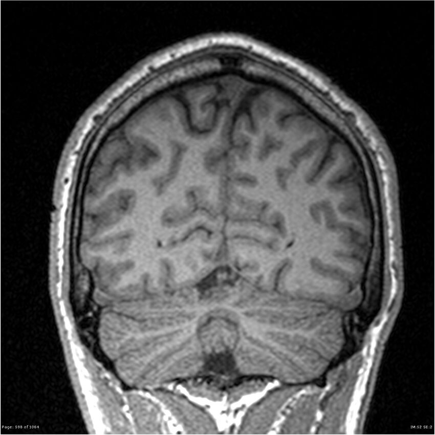 Normal brain MRI (non-focal epilepsy protocol) (Radiopaedia 38571-40700 Coronal T1 25).jpg