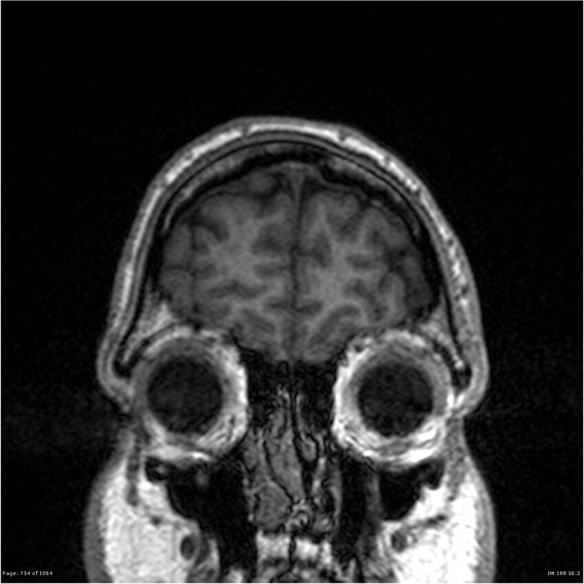 Normal brain MRI (non-focal epilepsy protocol) (Radiopaedia 38571-40700 Coronal T1 93).jpg