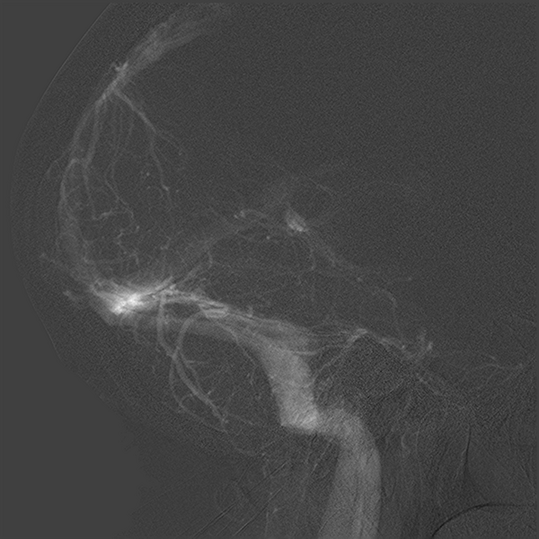 File:Normal cerebral angiogram (four vessel DSA) (Radiopaedia 41708-44649 L 19).png