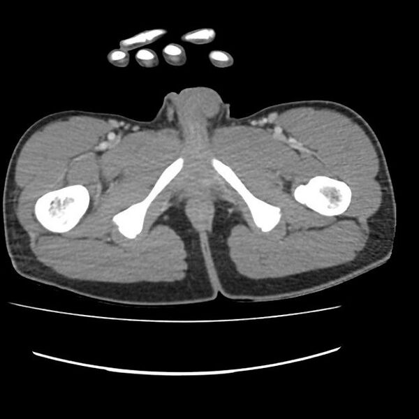 File:Normal dual-phase trauma CT chest,abdomen and pelvis (Radiopaedia 48092-52899 A 120).jpg