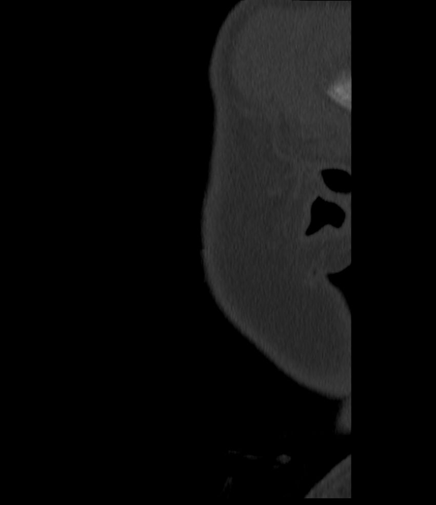 Normal facial bone CT (Radiopaedia 88742-105476 Sagittal bone window 161).jpg