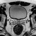 Normal prostate (MRI) (Radiopaedia 29986-30535 Axial T2 18).jpg