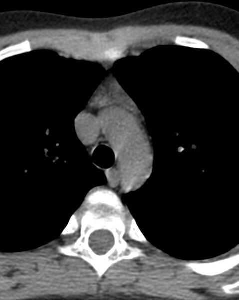 File:Normal thymus (Radiopaedia 39553-41859 Axial non-contrast 1).jpg