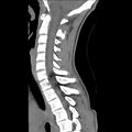 Normal trauma spine imaging (age 16) (Radiopaedia 45335-49358 C 20).jpg