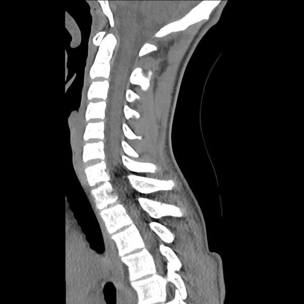 File:Normal trauma spine imaging (age 16) (Radiopaedia 45335-49358 C 20).jpg