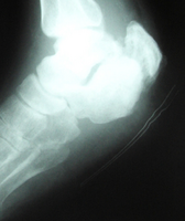 Standard Rx scan of right heel at end of treatment.