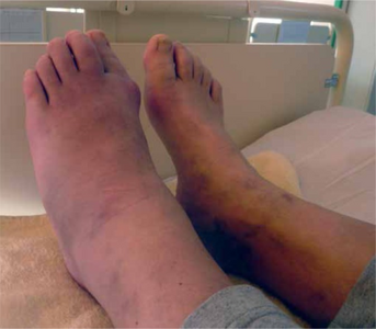 Left foot with Charcot arthropathy