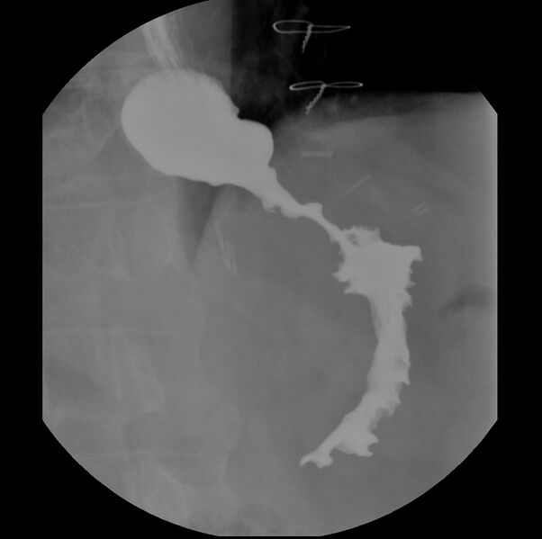 File:"Ballooning" of the distal esophagus after Heller myotomy (Radiopaedia 38485-40572 Supine - LPO 1).jpg