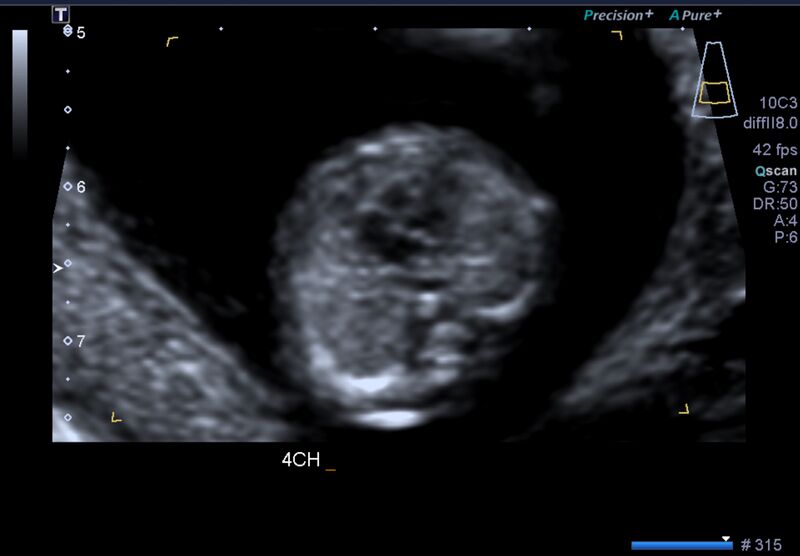 File:1st trimester nuchal-morphology ultrasound (Radiopaedia 44706-48477 General anatomy and NT 16).jpg
