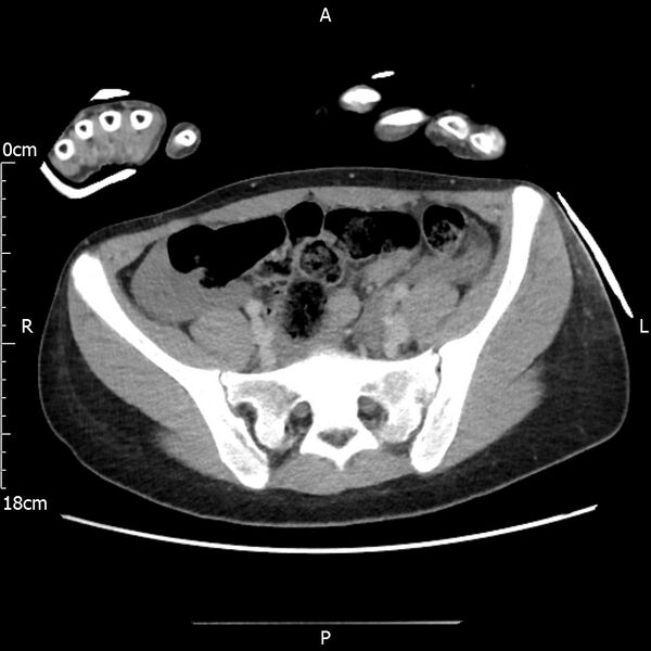 File:AAST grade IV kidney injury with CEUS follow-up (Radiopaedia 72353-82877 Axial C+ portal venous phase 56).jpg