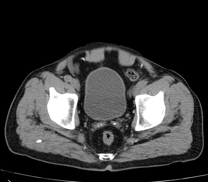 File:Abdominal aortic aneurysm (Radiopaedia 22421-22458 non-contrast 51).jpg