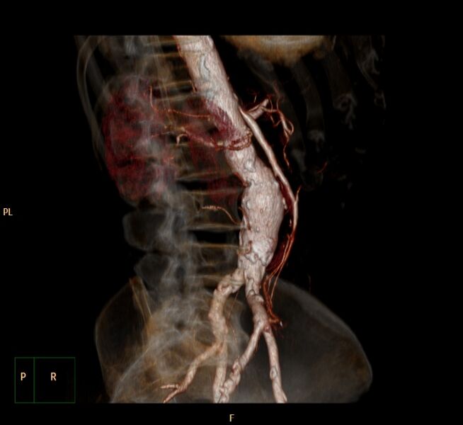 File:Abdominal aortic aneurysm (Radiopaedia 23703-23856 3D 9).jpg