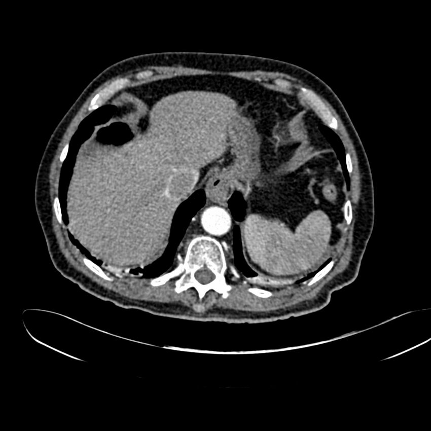 Abdominal aortic aneurysm (Radiopaedia 75131-86203 Axial C+ arterial phase 8).jpg