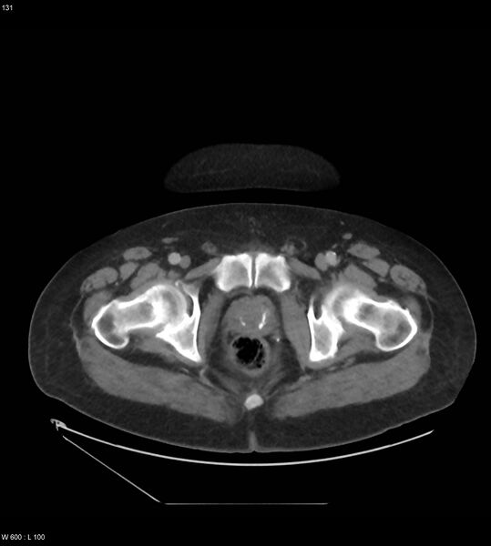 File:Abdominal aortic aneurysm with intramural hematoma then rupture (Radiopaedia 50278-55631 Axial C+ arterial phase 122).jpg