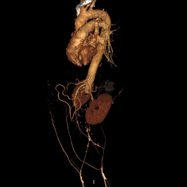 File:Abdominal aortic interposition tube graft and aneurysm thrombosis (Radiopaedia 71438-81857 3D VRT C+ arterial phase 4).jpg
